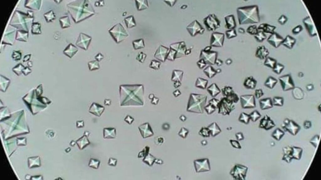 Presencia De Cristales De Oxalato De Calcio Dihidratado En La Orina